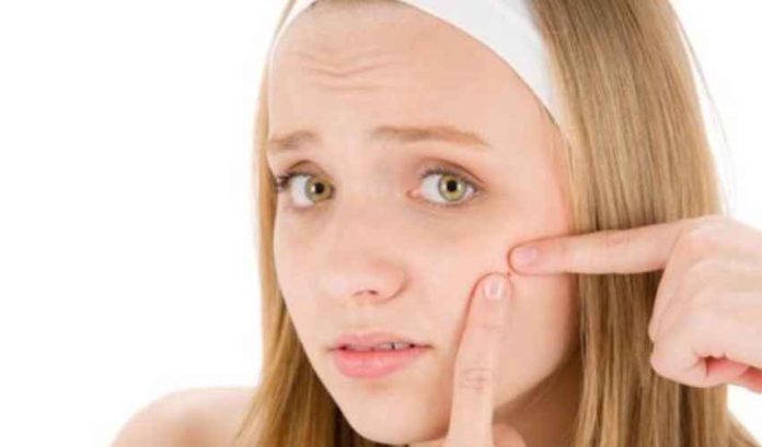 soigner l'acné naturellement